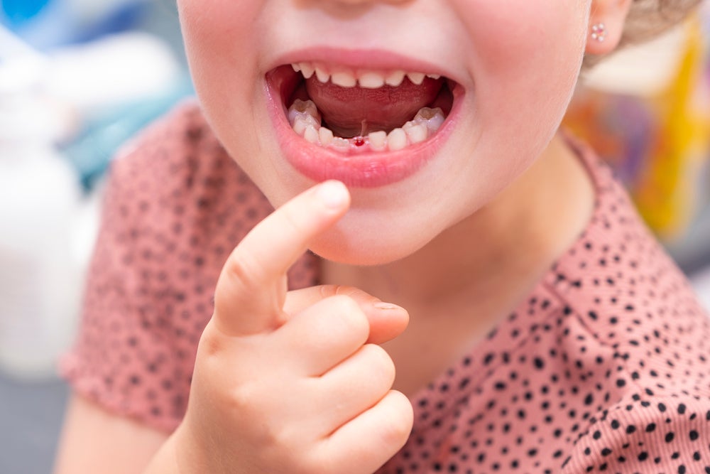 Uma criança com a boca aberta aponta para um dente de leite que caiu.