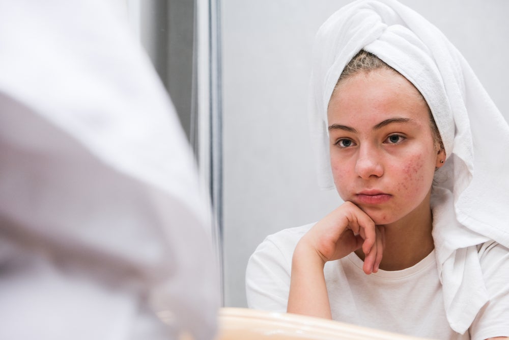 Menina branca, adolescente, se olha no espelho. Ela está com toalha de banho na cabeça, camiseta branca e tem marcas de acne espalhadas pelo rosto.