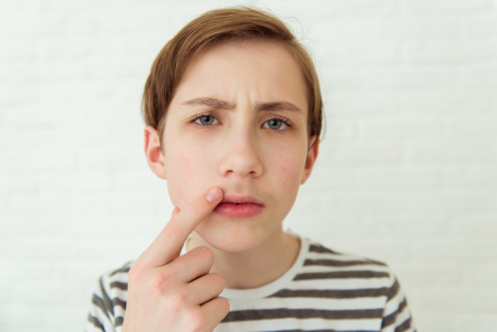 Um menino de olhos azuis e cabelo curto e loiro escuro, veste uma camiseta branca com listras horizontais pretas e aponta para a região do buço, sinalizando o crescimento de pelos. A foto faz alusão ao tema da puberdade precoce. 