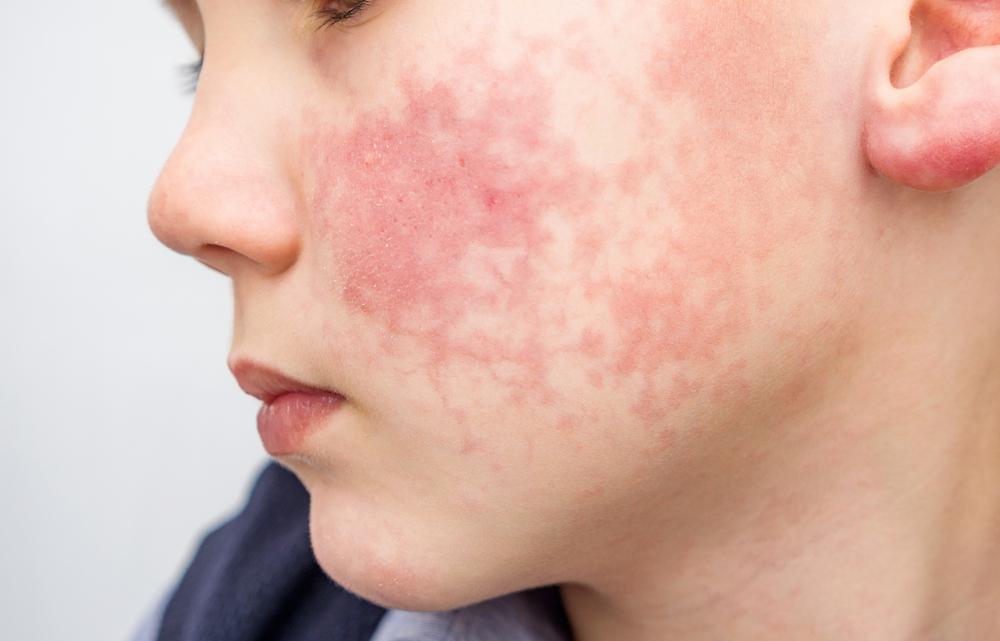 Foto de uma criança com alergia alimentar. Em destaque, está a bochecha do garoto com marcas bem vermelhas e irritação de pele..