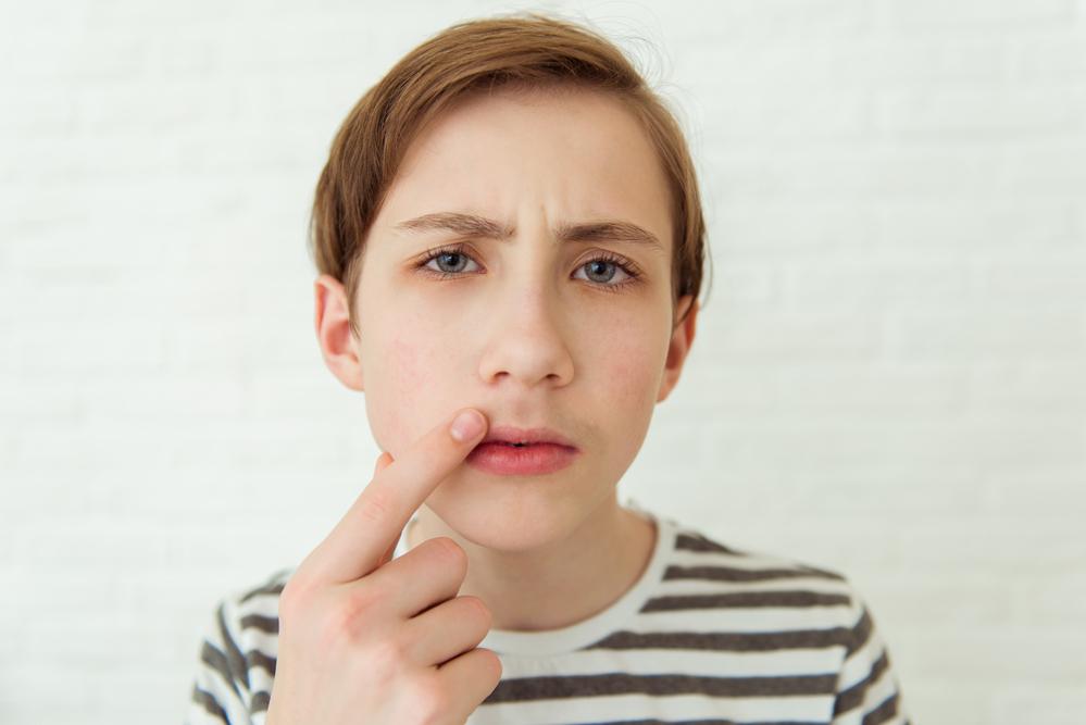 Um menino de olhos azuis e cabelo curto e loiro escuro, veste uma camiseta branca com listras horizontais pretas e aponta para a região do buço, sinalizando o crescimento de pelos. A foto faz alusão ao tema da puberdade precoce. 